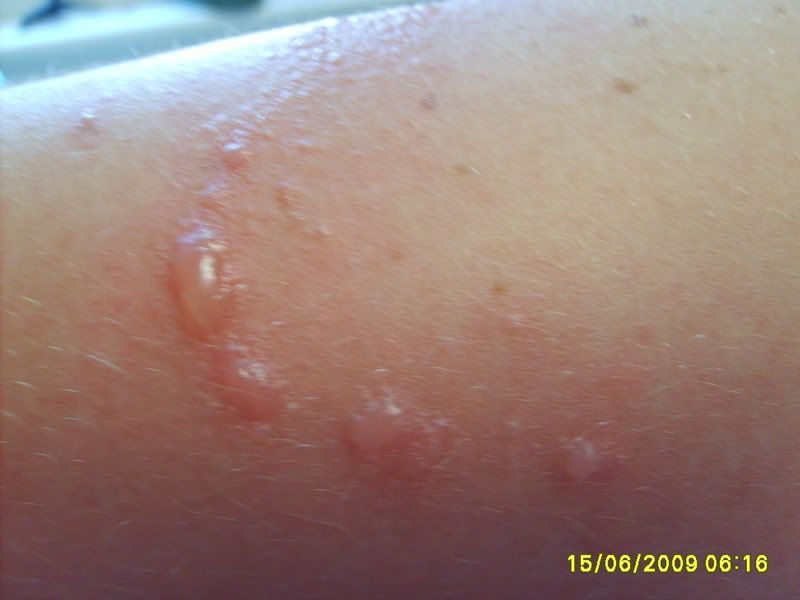 poison ivy on arm pictures, photos